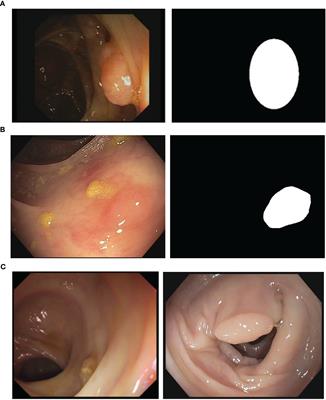 A complete benchmark for polyp detection, segmentation and classification in colonoscopy images